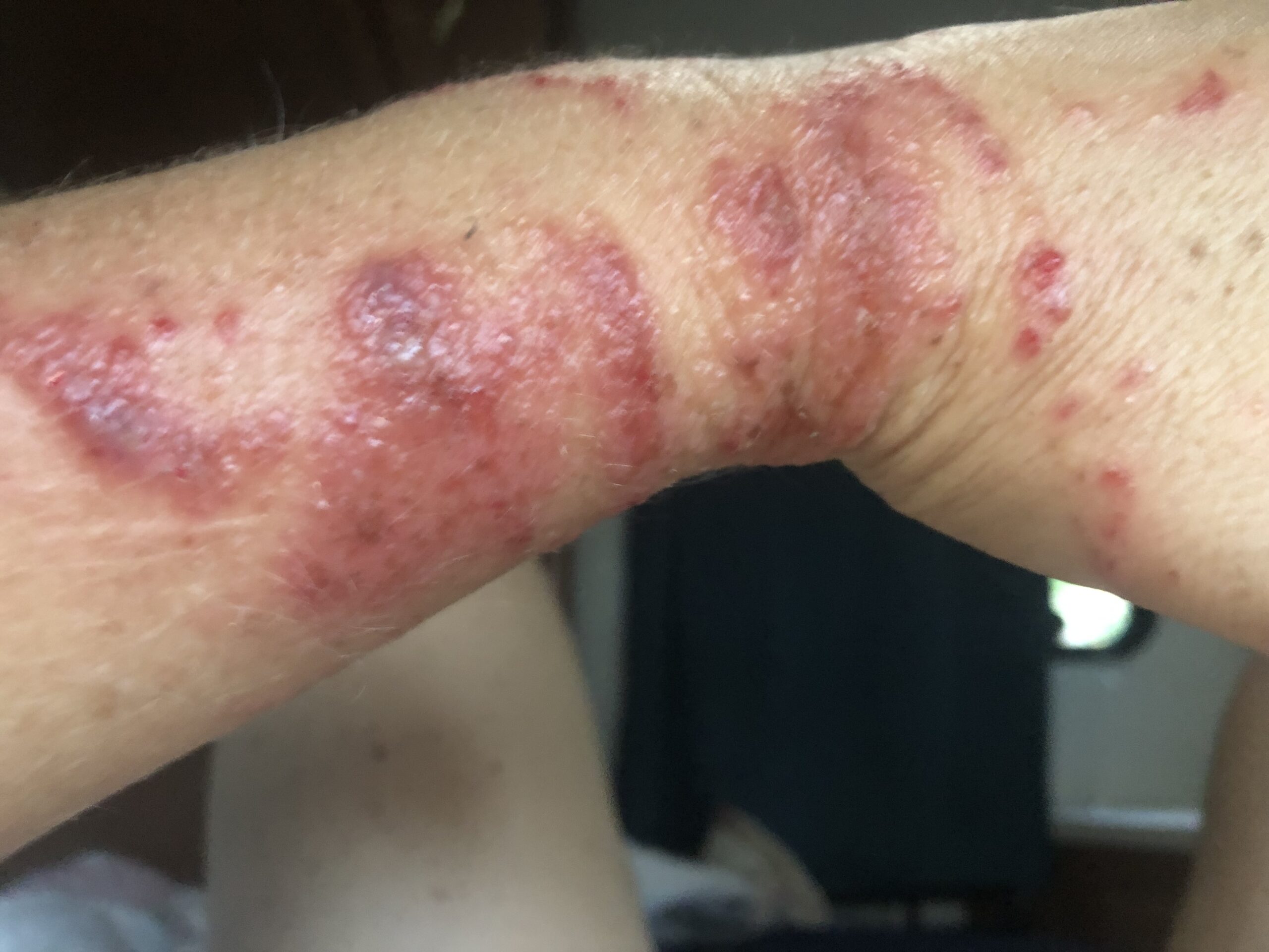 Scabies…the parasite from hell.